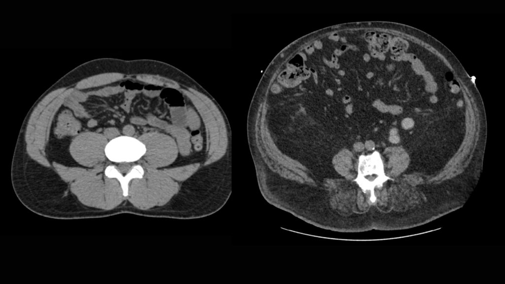 Visceral fat transverse plane